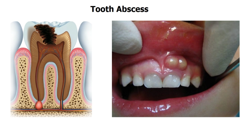 tooth abscess