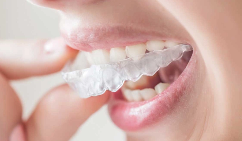 plastic retainer lifespan