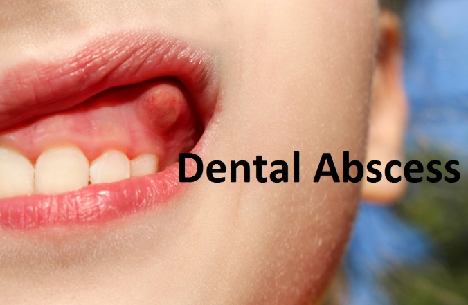 tooth abscess