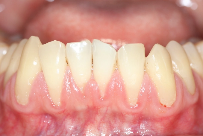 regrow receding gums