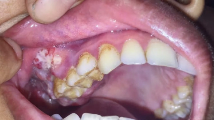 oral cancer symptoms oral cancer symptoms