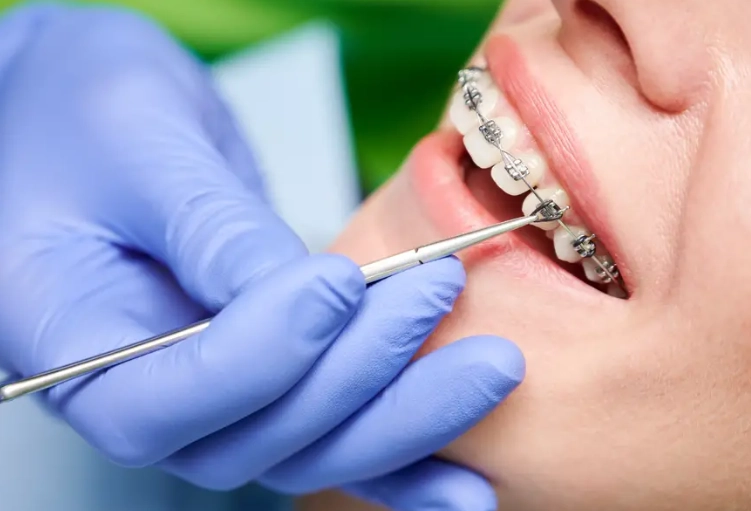 enamel contouring procedure