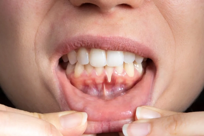 gum recession treatment