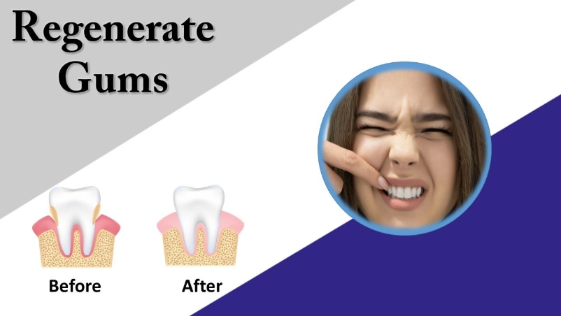 regrow receding gums