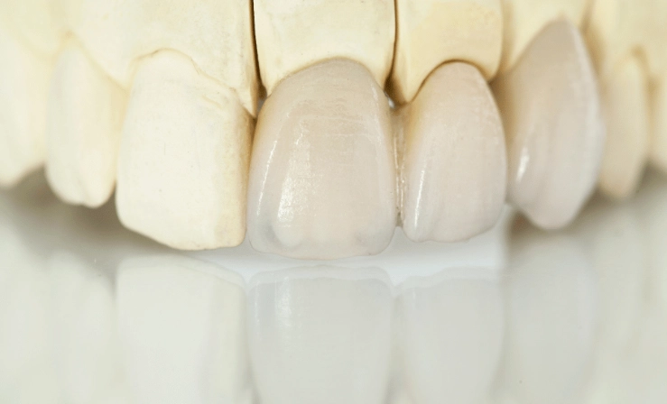 permanent dental adhesive