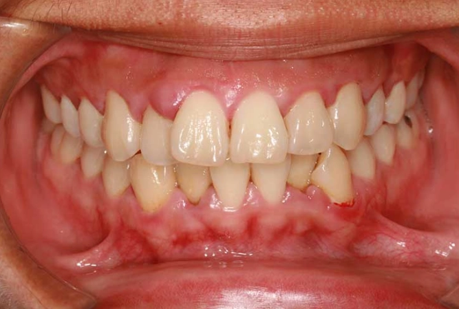 gingivitis symptoms gingivitis symptoms