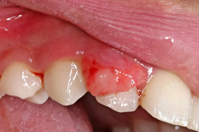 cancerous gum lesions cancerous gum lesions