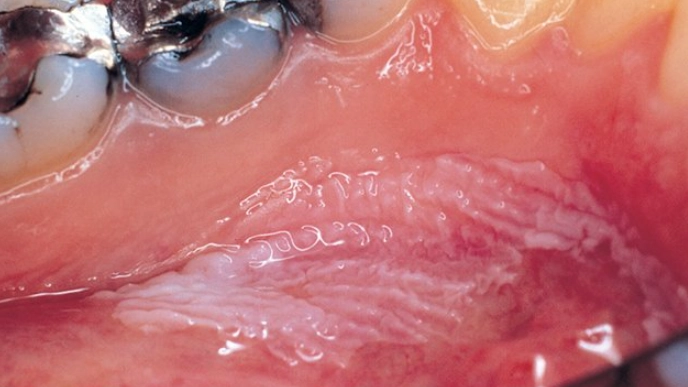 oral cancer symptoms oral cancer symptoms