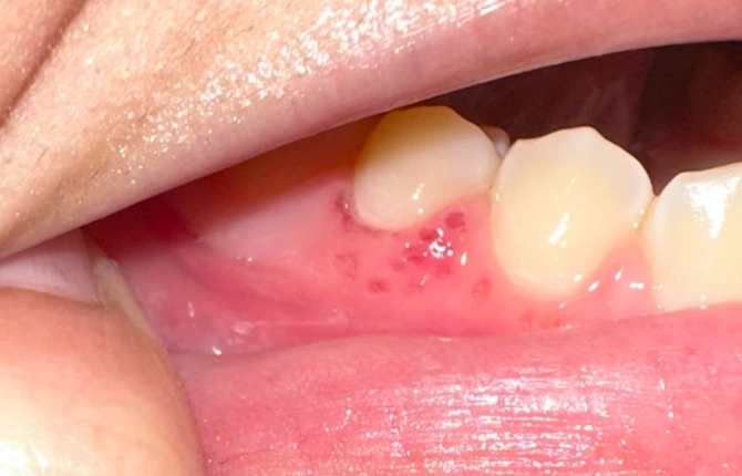 gingivitis symptoms gingivitis symptoms