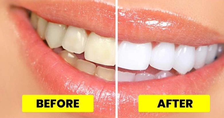 teeth whitening at home fast teeth whitening at home fast