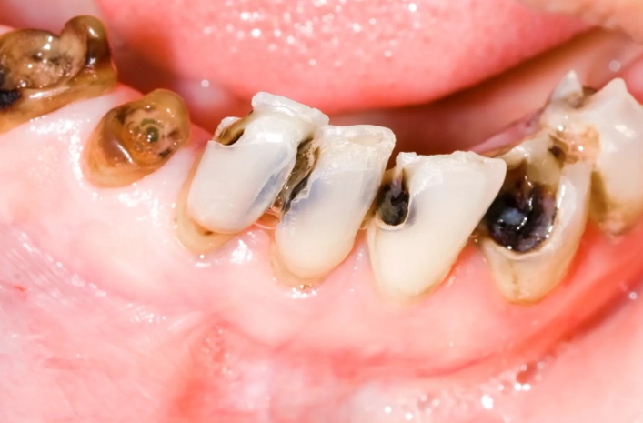 baby bottle tooth decay