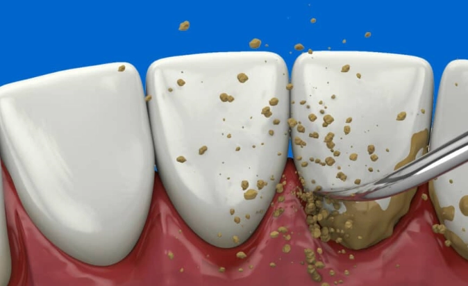 deep cleaning risks deep cleaning risks