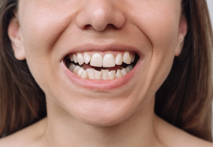 worst foods for teeth worst foods for teeth