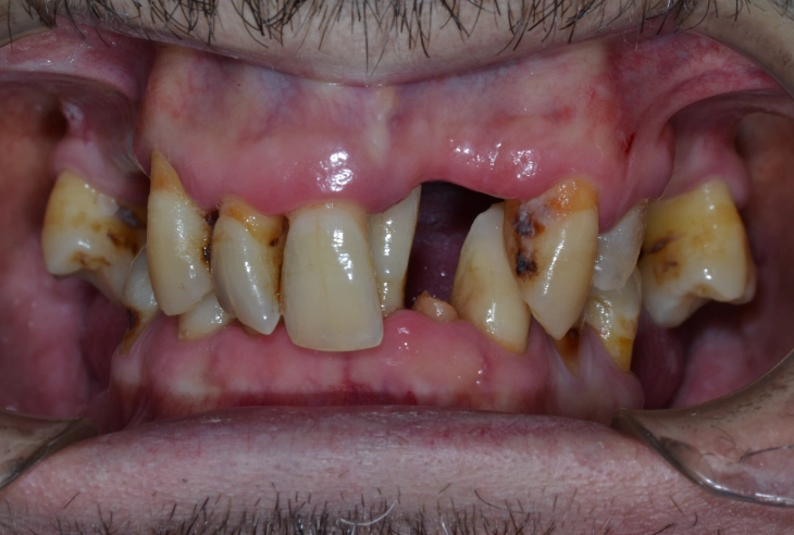 what destroys teeth the most what destroys teeth the most