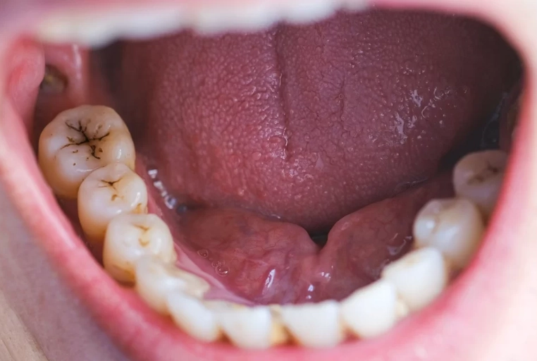 early childhood caries