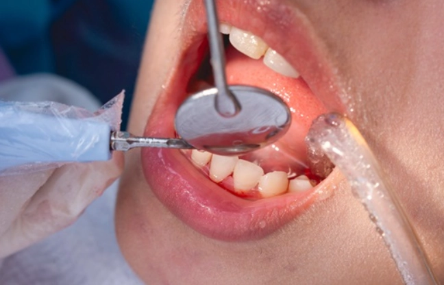 scaling and root planing duration