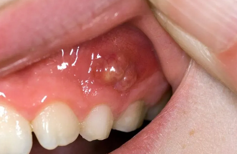 root canal for abscess