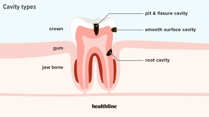tooth cavity pain relief
