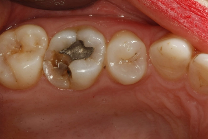 how to fix a chipped molar