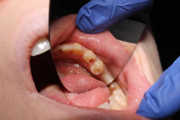 tooth abscess home remedy