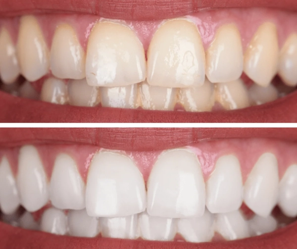 deep cleaning teeth disadvantages