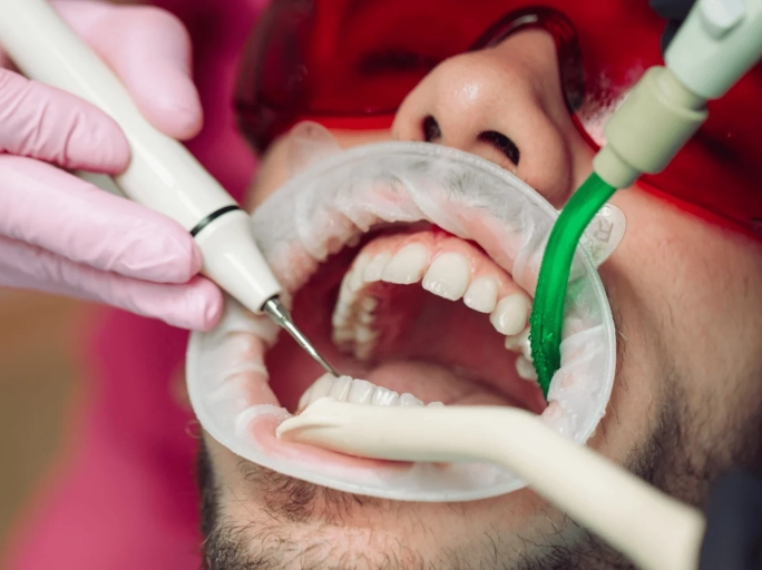 scaling and root planing risks