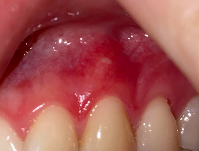 gum inflammation