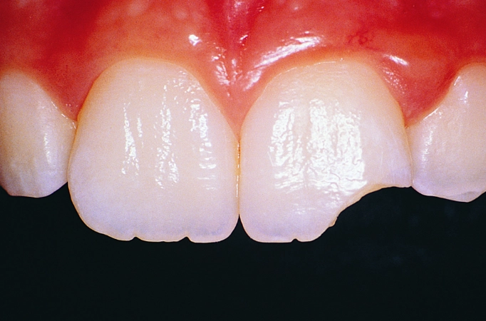 chipped tooth repair