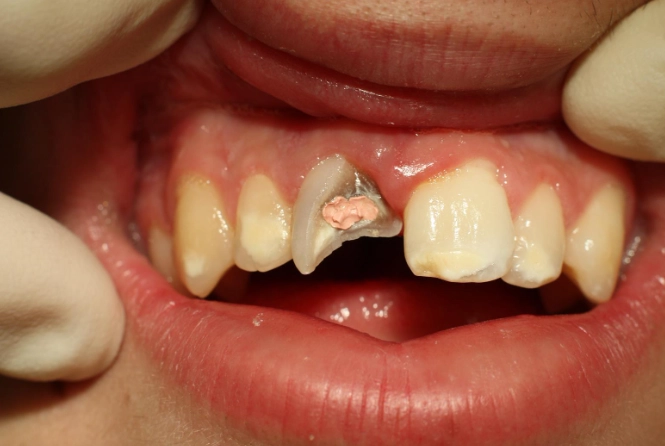 chipped tooth repair