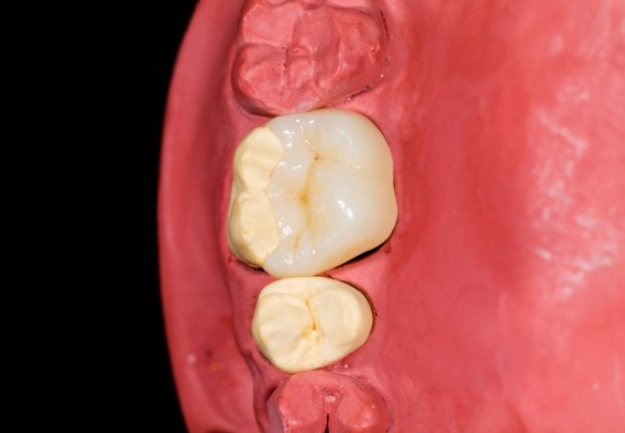 how to fix a chipped molar