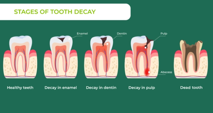 how to stop tooth cavity pain