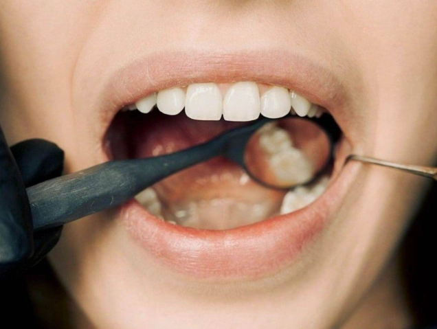 deep cleaning side effects