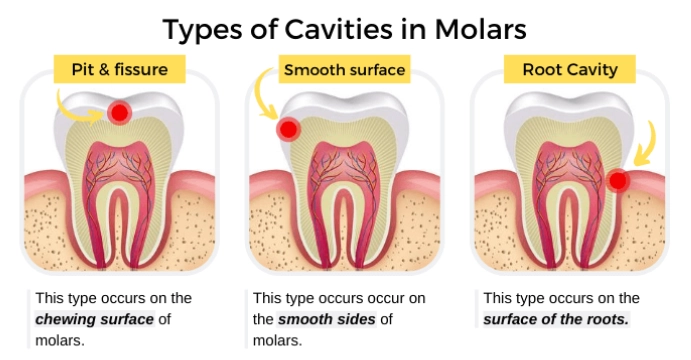 cavity pain symptoms