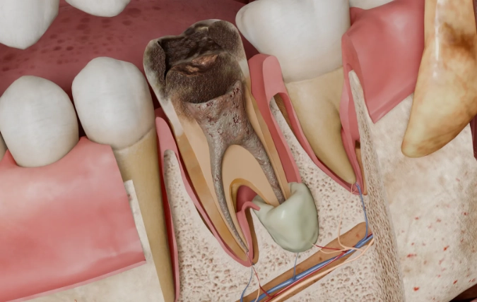 periapical abscess treatment