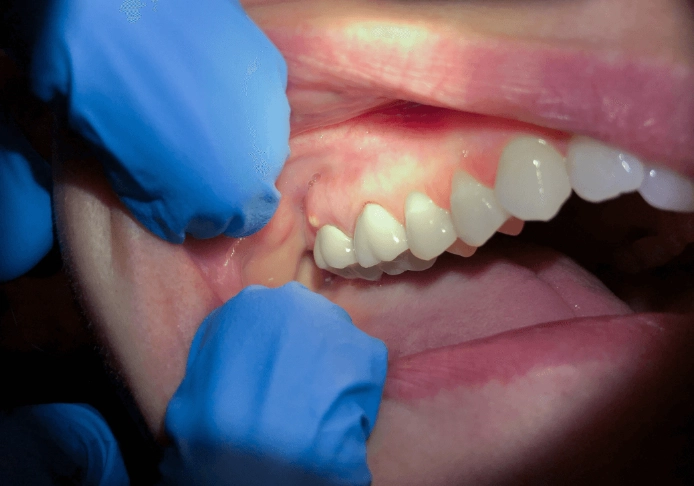 tooth abscess home remedy