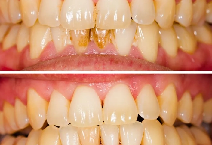 what to expect after deep cleaning