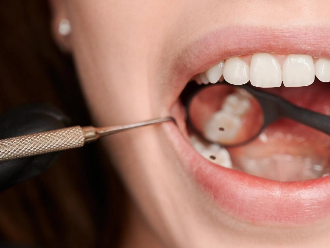 how to know if you have a cavity