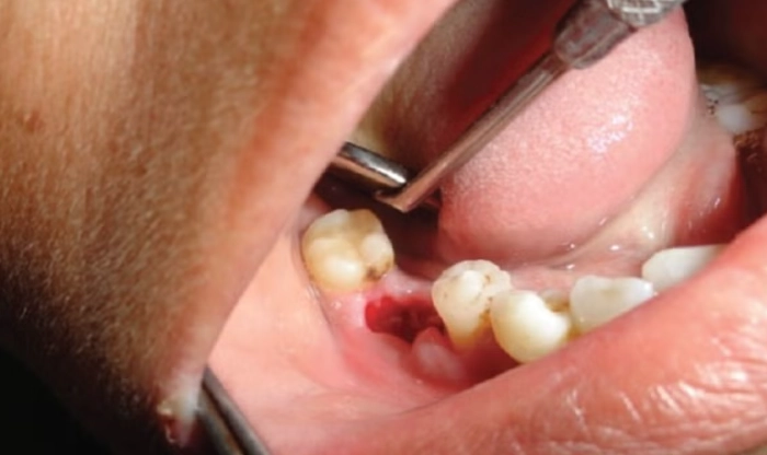 wisdom teeth extraction recovery day by day