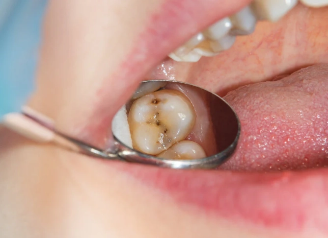 early signs of tooth decay