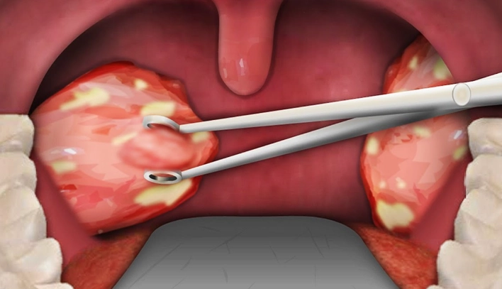 tonsil stones removal