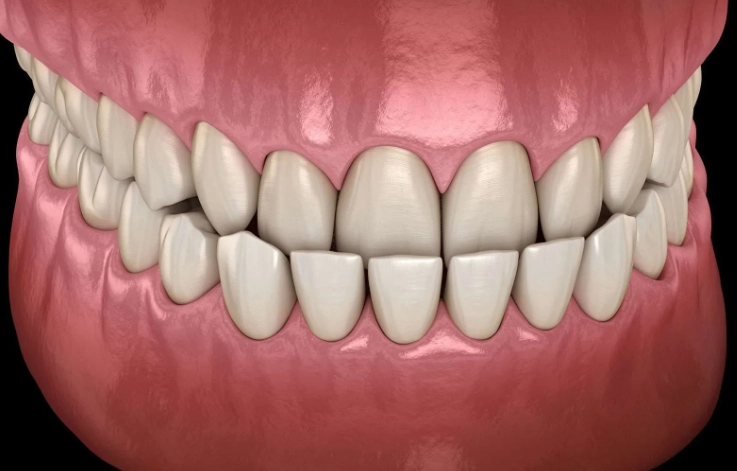 underbite correction without surgery