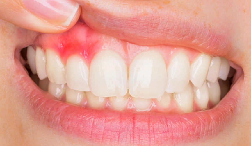 gum disease symptoms