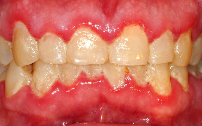 gingivitis red spot on gums