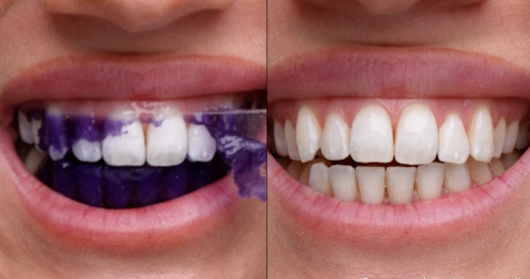 fast teeth whitening reviews