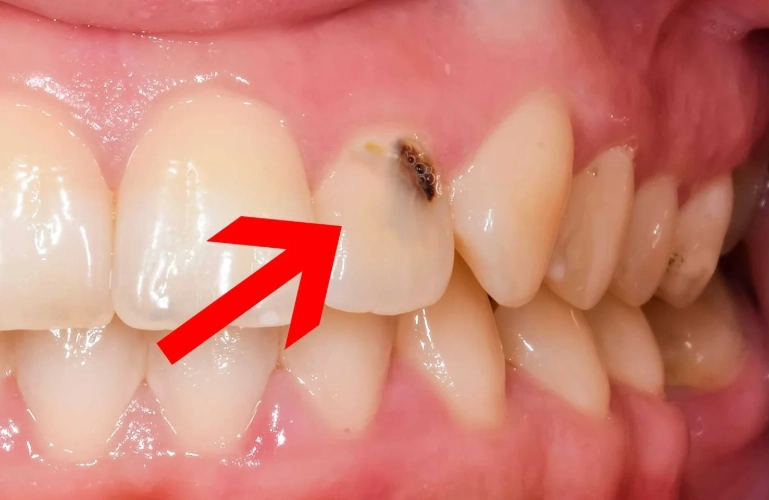 cavity pain relief cavity pain relief