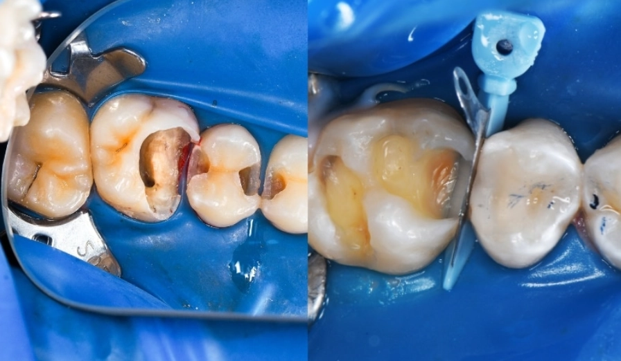 dental filling pain dental filling pain