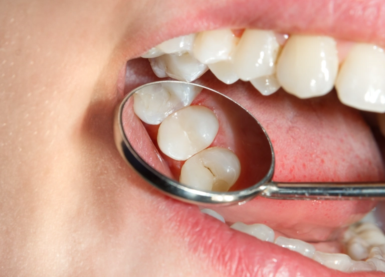 home remedies for cavity pain home remedies for cavity pain