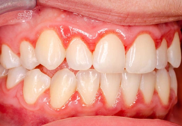 gingivitis red spot on gums