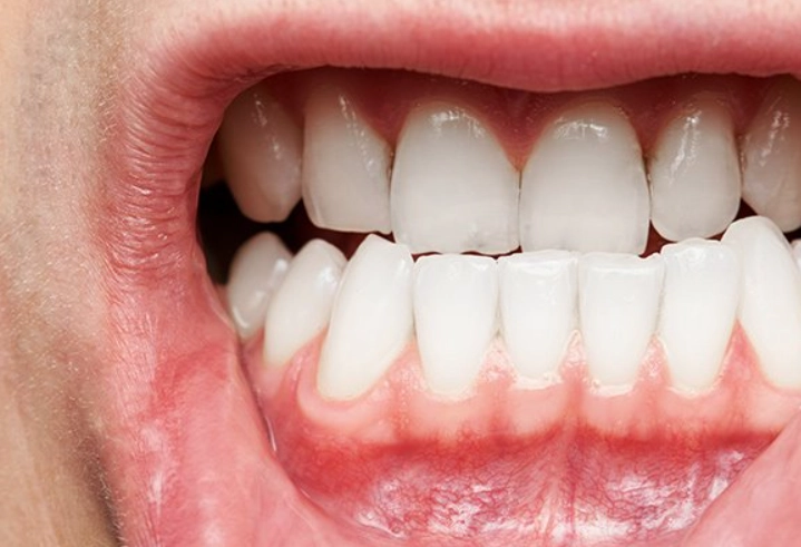 gingivitis red spot on gums
