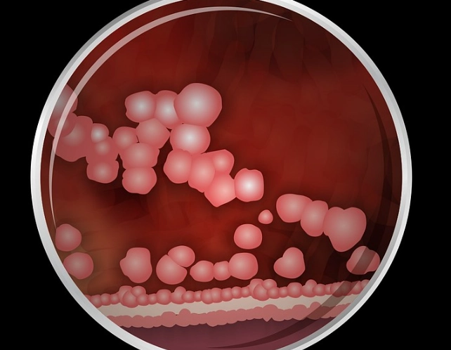 how to treat P. gingivalis how to treat P. gingivalis